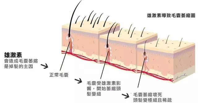 怎样植发拥有更完美的发际线？