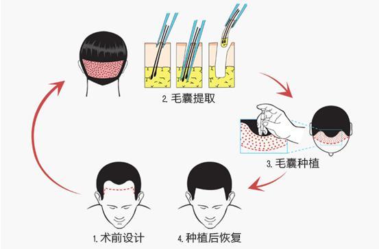 植发和织发补发的区别究竟哪个比较好？