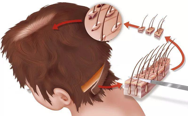 全民脱发时代是时候了解植发这门技术了