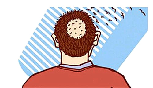 头上疤痕导致的脱发，可以植发治疗吗？