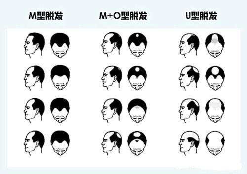 脱发原因-南京新生植发带你了解几大脱发原因