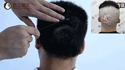 南京新生植发科普疤痕植发怎么治疗