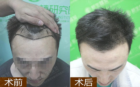 疤性脱发可以通过植发来解决吗？