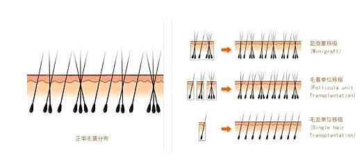 选植发技术之前先了解这四点