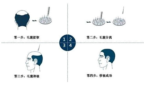 关于植发的原理是什么个过程呢？可靠吗？好不好？