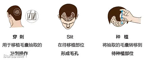 NoCut不剃发植发技术解决多年脱发困扰