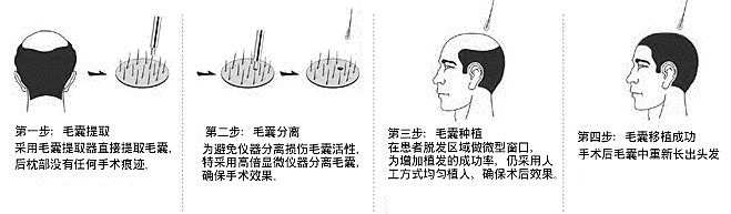 FUE无痕植发技术