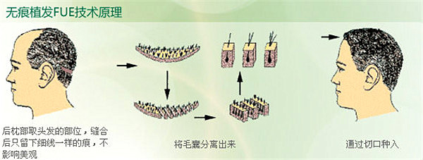 发际线种植的效果怎么样？