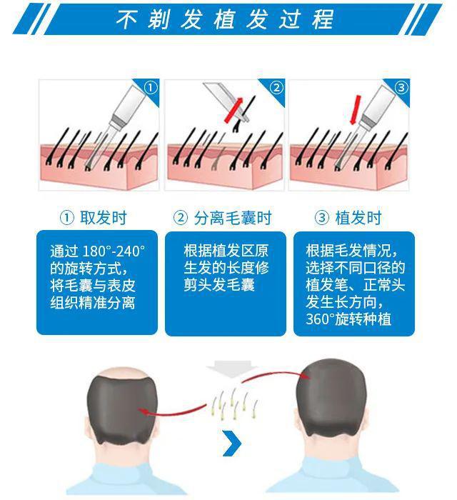 不剃发植发颜值再升级，美丽不可“剃”代