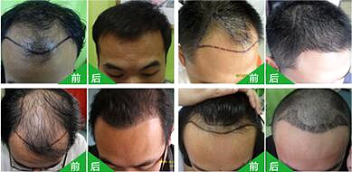 专家解答头发种植常见的五大问题