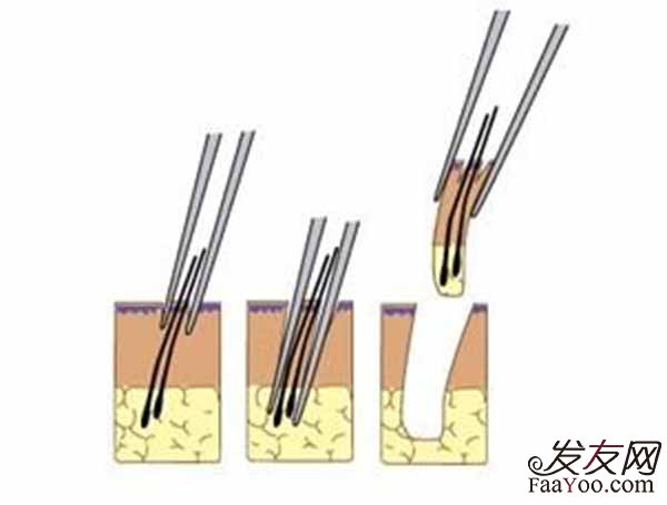 毛发移植如何保障毛囊存活率呢？