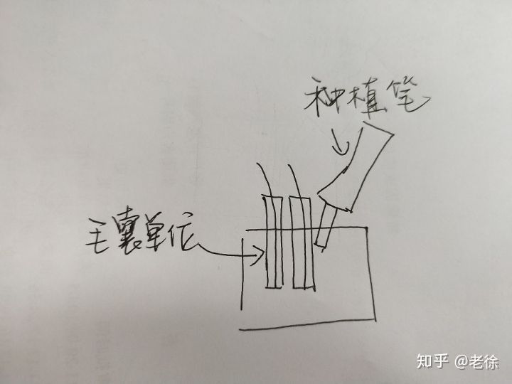 你需要植发吗？怎么判断自己适不适合植发？