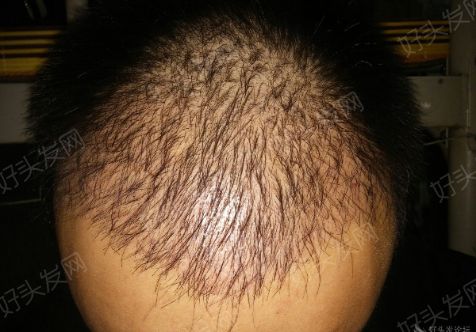 成都科发源：植发是治疗脱发的良方