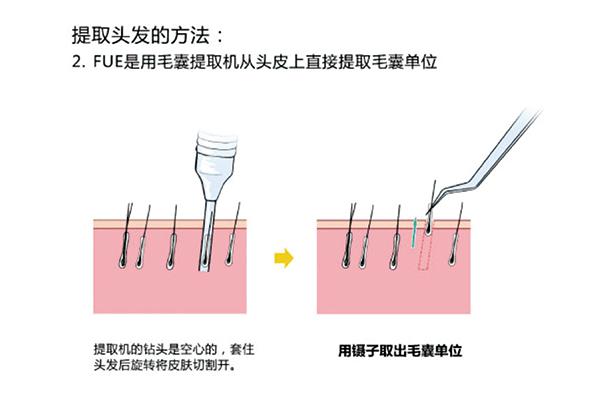 疤痕种植头发的效果好吗