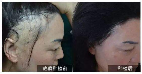烫伤疤痕可以植发吗？疤痕植发的技术有哪些？
