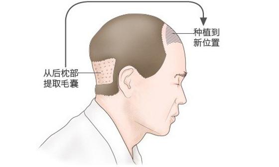 种植发际线会失败吗，发际线种植会失败吗