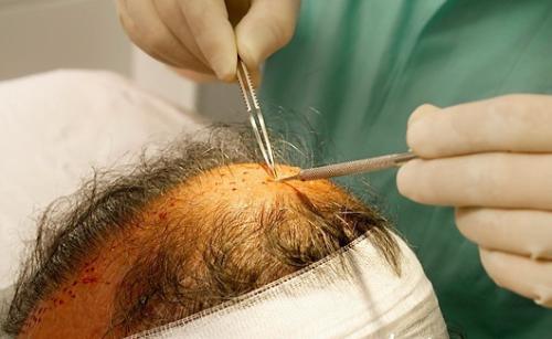 影响植发毛囊存活率的因素有哪些