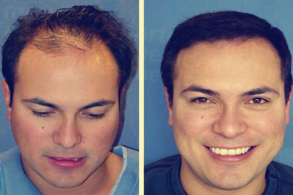 FUE植发手术的优点是什么？植发前用不用剃光头？