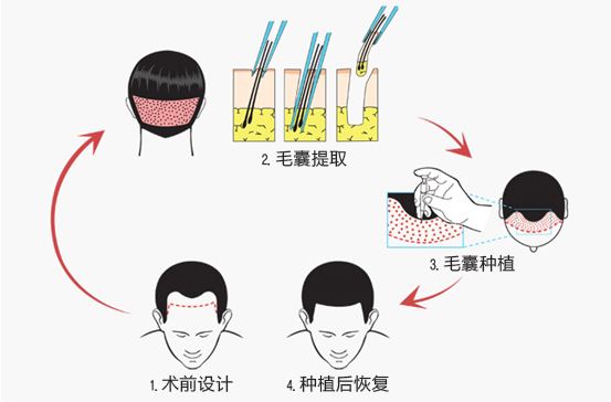 种植头发的手术要多长时间？
