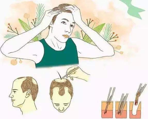 植发手术可以使用别人的毛囊吗？