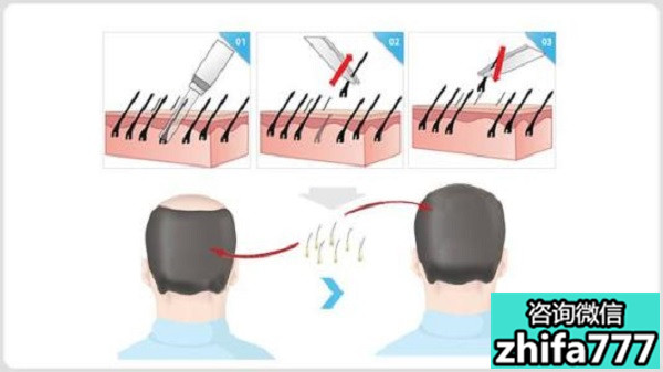 关于毛发移植你知道多少