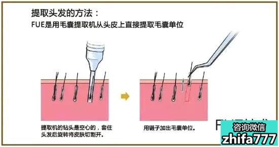 目前的植发技术中有哪些？