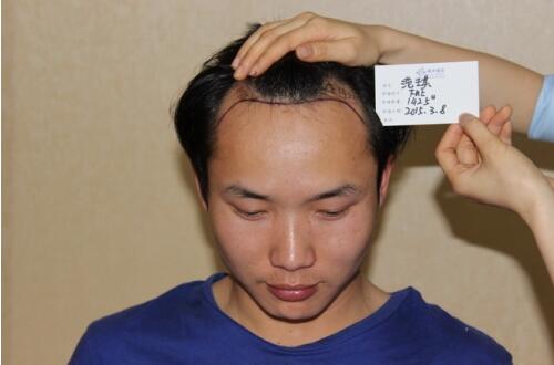 在广州做的发际线移植手术，没剃头啊