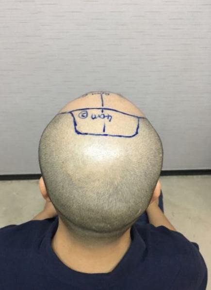 脱发9年，在广州新发现植发做了毛发移植手术