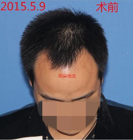 从上海到北京熙朵做了2次植发，一次是发际线移植，一次是头顶加密