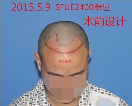 从上海到北京熙朵做了2次植发，一次是发际线移植，一次是头顶加密