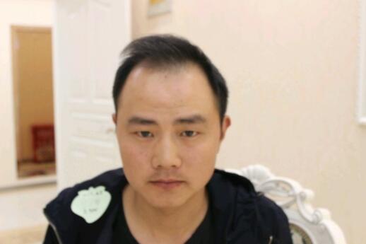 上海科发源做的毛发移植手术，分享手术后的效果