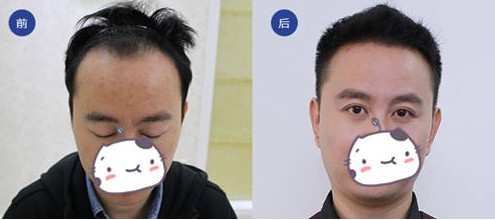 杭州做发际线植发是多少？