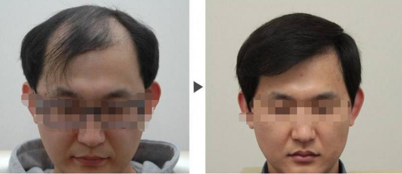 哪些人适合做毛发移植手术呢？宁波鄞州同仁头发种植有什么优势？