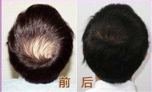 加密植发和普通植发有什么区别
