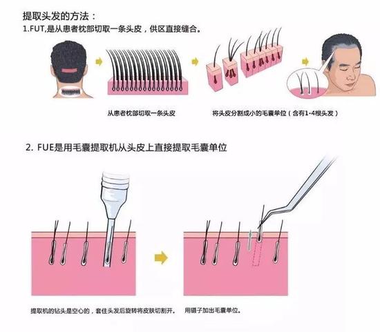 扬州市毛发移植手术的过程复杂吗