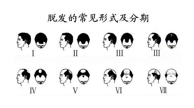 郑州头发移植手术技术好不好 效果如何呢