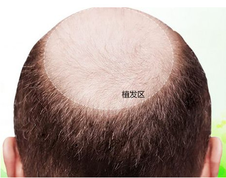 头发移植手术后需要多长时间恢复呢？