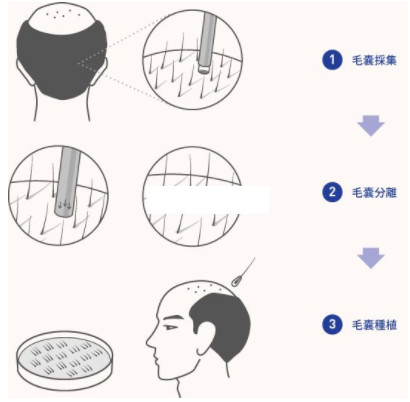 头发移植手术后需要多长时间恢复呢？