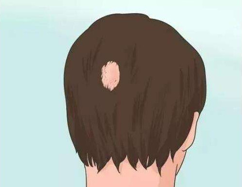 影响疤痕毛发移植效果的因素有哪些呢