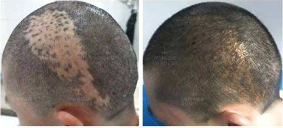 影响疤痕毛发移植效果的因素有哪些呢
