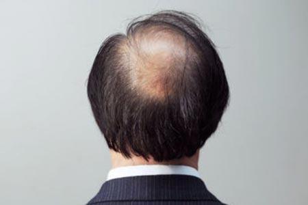做头发种植手术有哪些优势
