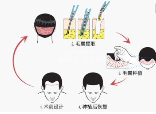 头发移植有哪些优点呢