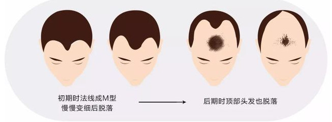西安科发源毛发移植后多长时间能看到效果