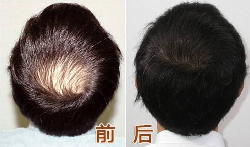 头发种植技术怎么样 效果好吗