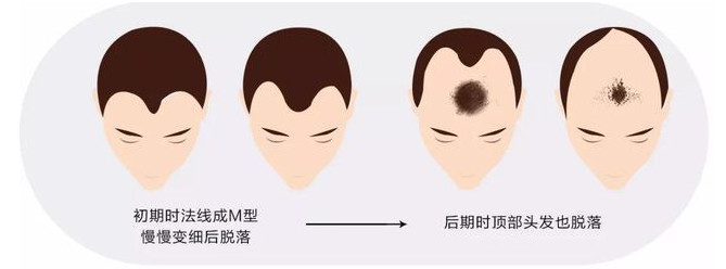 影响头发种植效果的因素有哪些？