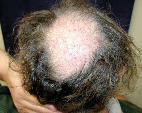 男性植发最多能提取多少毛囊单位