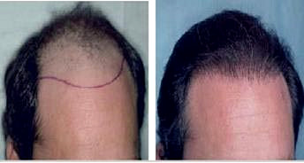 FUT植发技术真的没疤痕吗？有什么优缺点？