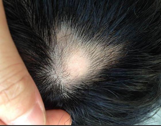一年的手术疤痕可以做植发吗
