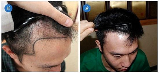 头发种植技术可靠吗