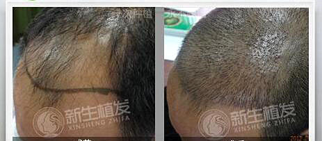 治疗脱发，三大因素影响植发手术时间